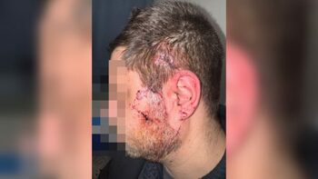« J’ai peur qu’il croise ma copine seule » : agressé au tesson de bouteille, il témoigne